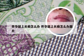 怀孕腿上长癣怎么办 怀孕腿上长癣怎么办图片