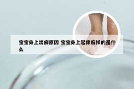 宝宝身上出癣原因 宝宝身上起像癣样的是什么