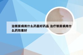 治银屑病用什么药最好药品 治疗银屑病用什么药效果好