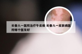 长春八一医院治疗牛皮癣 长春八一皮肤病医院哪个医生好