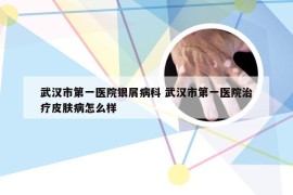 武汉市第一医院银屑病科 武汉市第一医院治疗皮肤病怎么样