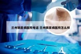 兰州银屑病医院电话 兰州银屑病医院怎么样