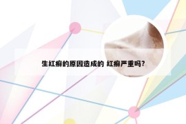 生红癣的原因造成的 红癣严重吗?