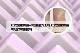 红皮型银屑病可以用达力士吗 红皮型银屑病可以打可善挺吗