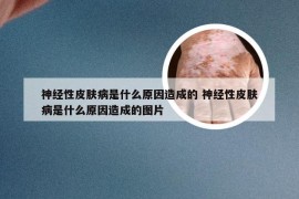 神经性皮肤病是什么原因造成的 神经性皮肤病是什么原因造成的图片