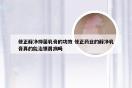 修正藓净抑菌乳膏的功效 修正药业的藓净乳膏真的能治银屑病吗