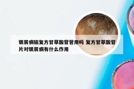 银屑病输复方甘草酸苷管用吗 复方甘草酸苷片对银屑病有什么作用