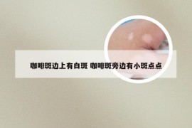 咖啡斑边上有白斑 咖啡斑旁边有小斑点点