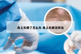 身上长癣了怎么办 身上长癣怎样治