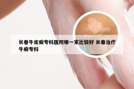 长春牛皮癣专科医院哪一家比较好 长春治疗牛癣专科