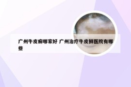 广州牛皮癣哪家好 广州治疗牛皮鲜医院有哪些