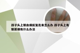 孩子头上银血病反复出来怎么办 孩子头上有银屑病有什么办法