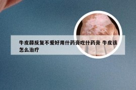 牛皮薜反复不爱好用什药膏吃什药膏 牛皮该怎么治疗