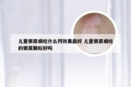 儿童银屑病吃什么钙效果最好 儿童银屑病吃的银屑颗粒好吗