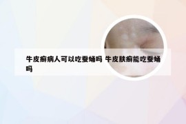 牛皮癣病人可以吃蚕蛹吗 牛皮肤癣能吃蚕蛹吗