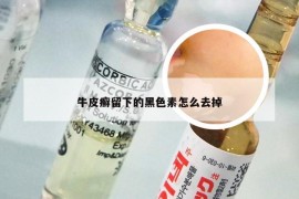 牛皮癣留下的黑色素怎么去掉