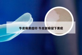 牛皮癣黑痘印 牛皮肤癣留下黑疤