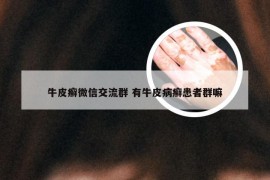 牛皮癣微信交流群 有牛皮病癣患者群嘛