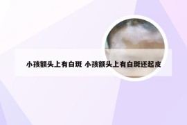 小孩额头上有白斑 小孩额头上有白斑还起皮