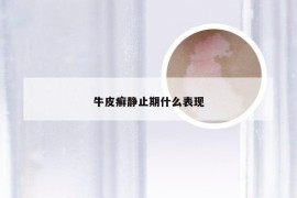 牛皮癣静止期什么表现