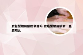 脓包型银屑病脸会肿吗 脓疱型银屑病会一直脓疱么