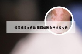 银屑病换血疗法 银屑病换血疗法多少钱