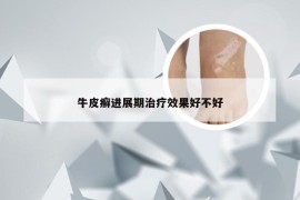 牛皮癣进展期治疗效果好不好