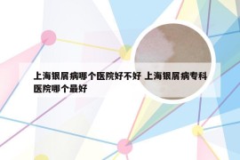 上海银屑病哪个医院好不好 上海银屑病专科医院哪个最好