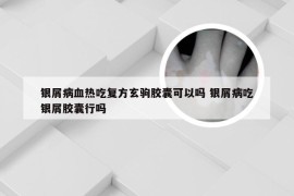 银屑病血热吃复方玄驹胶囊可以吗 银屑病吃银屑胶囊行吗