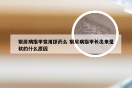 银屑病指甲变用搽药么 银屑病指甲长出来是软的什么原因