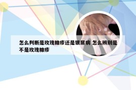 怎么判断是玫瑰糠疹还是银屑病 怎么辨别是不是玫瑰糠疹