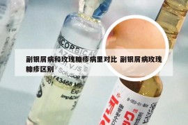 副银屑病和玫瑰糠疹病里对比 副银屑病玫瑰糠疹区别