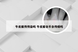 牛皮廨传传染吗 牛皮廨会不会传痒吗