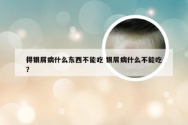 得银屑病什么东西不能吃 银屑病什么不能吃?