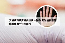 艾滋病和银屑病的症状一样吗 艾滋病和银屑病的症状一样吗图片