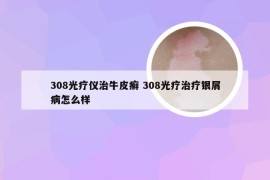 308光疗仪治牛皮癣 308光疗治疗银屑病怎么样