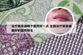 治疗银屑病哪个医院好一点 全国治疗银屑病最好的医院排名