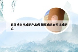 银屑病能用减肥产品吗 银屑病患者可以减肥吗