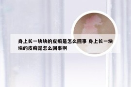 身上长一块块的皮癣是怎么回事 身上长一块块的皮癣是怎么回事啊