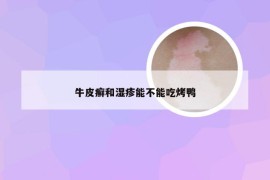 牛皮癣和湿疹能不能吃烤鸭