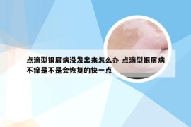 点滴型银屑病没发出来怎么办 点滴型银屑病不痒是不是会恢复的快一点