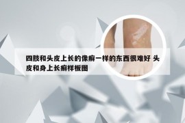 四肢和头皮上长的像癣一样的东西很难好 头皮和身上长癣样板图