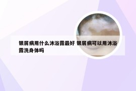 银屑病用什么沐浴露最好 银屑病可以用沐浴露洗身体吗