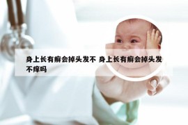 身上长有癣会掉头发不 身上长有癣会掉头发不痒吗