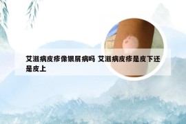 艾滋病皮疹像银屑病吗 艾滋病皮疹是皮下还是皮上