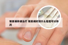 银屑病停课治疗 银屑病好到什么程度可以停药