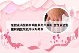 急性点滴型银屑病复发概率大吗 急性点滴型银屑病复发概率大吗知乎