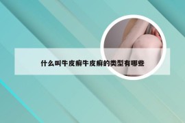 什么叫牛皮癣牛皮癣的类型有哪些