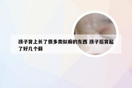 孩子背上长了很多类似癣的东西 孩子后背起了好几个藓