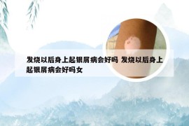 发烧以后身上起银屑病会好吗 发烧以后身上起银屑病会好吗女